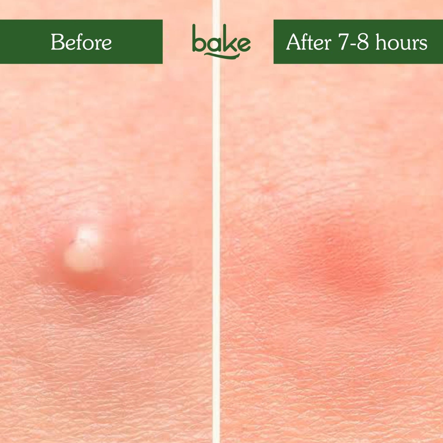 Zit Erase Micro point Patches for Active Acne & Breakouts - 9 Patches