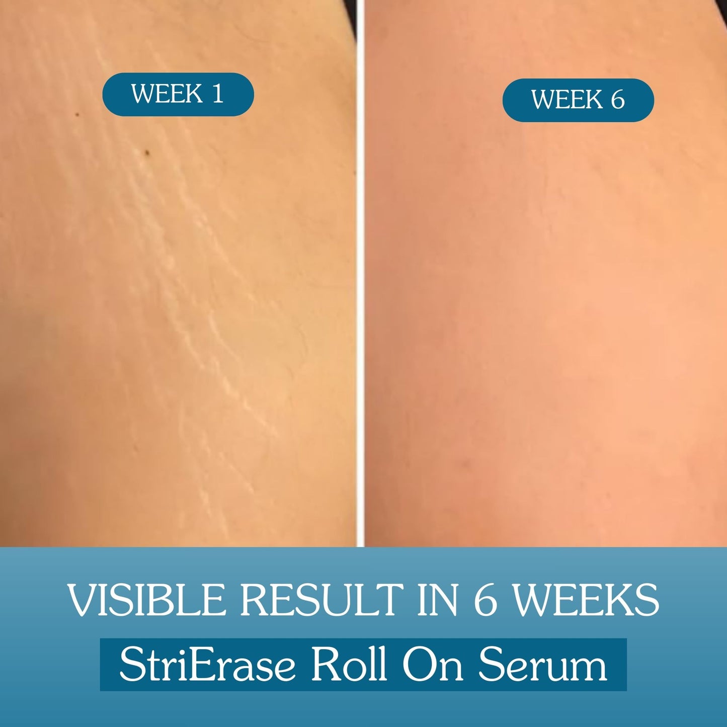 StriErase™ Stretch Marks Removal Roll On Serum
