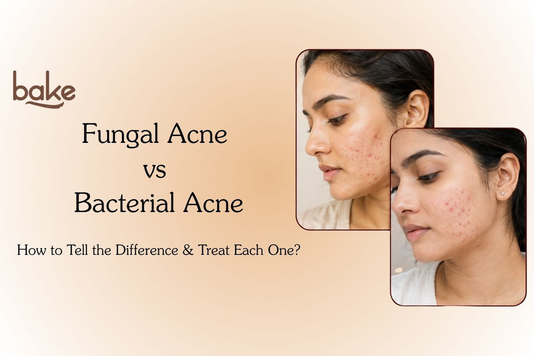 Fungal Acne vs Bacterial Acne: How to Tell the Difference in Monsoon?
