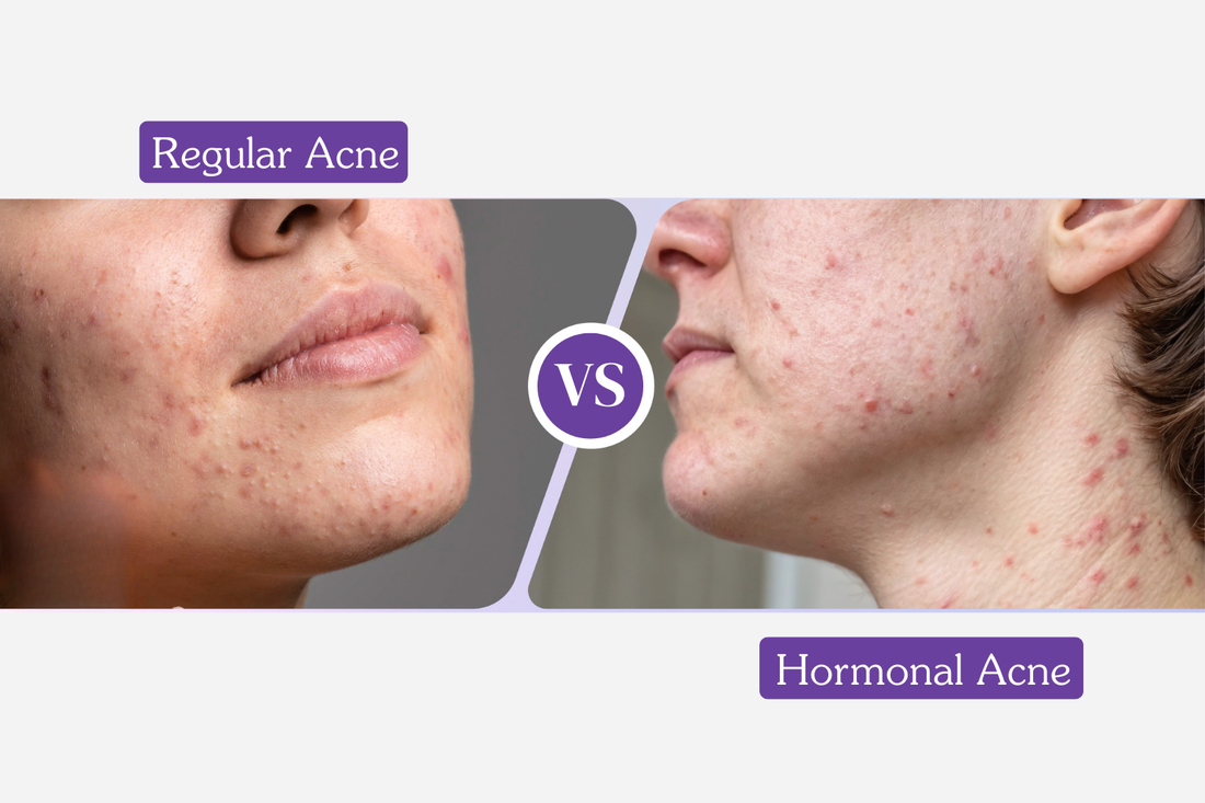 Hormonal Acne vs Regular Acne: How to Tell the Difference and Treat Each One