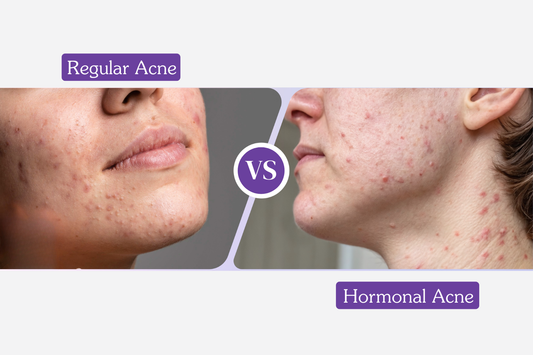 Hormonal Acne vs Regular Acne: How to Tell the Difference and Treat Each One