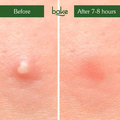 Zit Erase Micro point Patches for Active Acne & Breakouts - 9 Patches