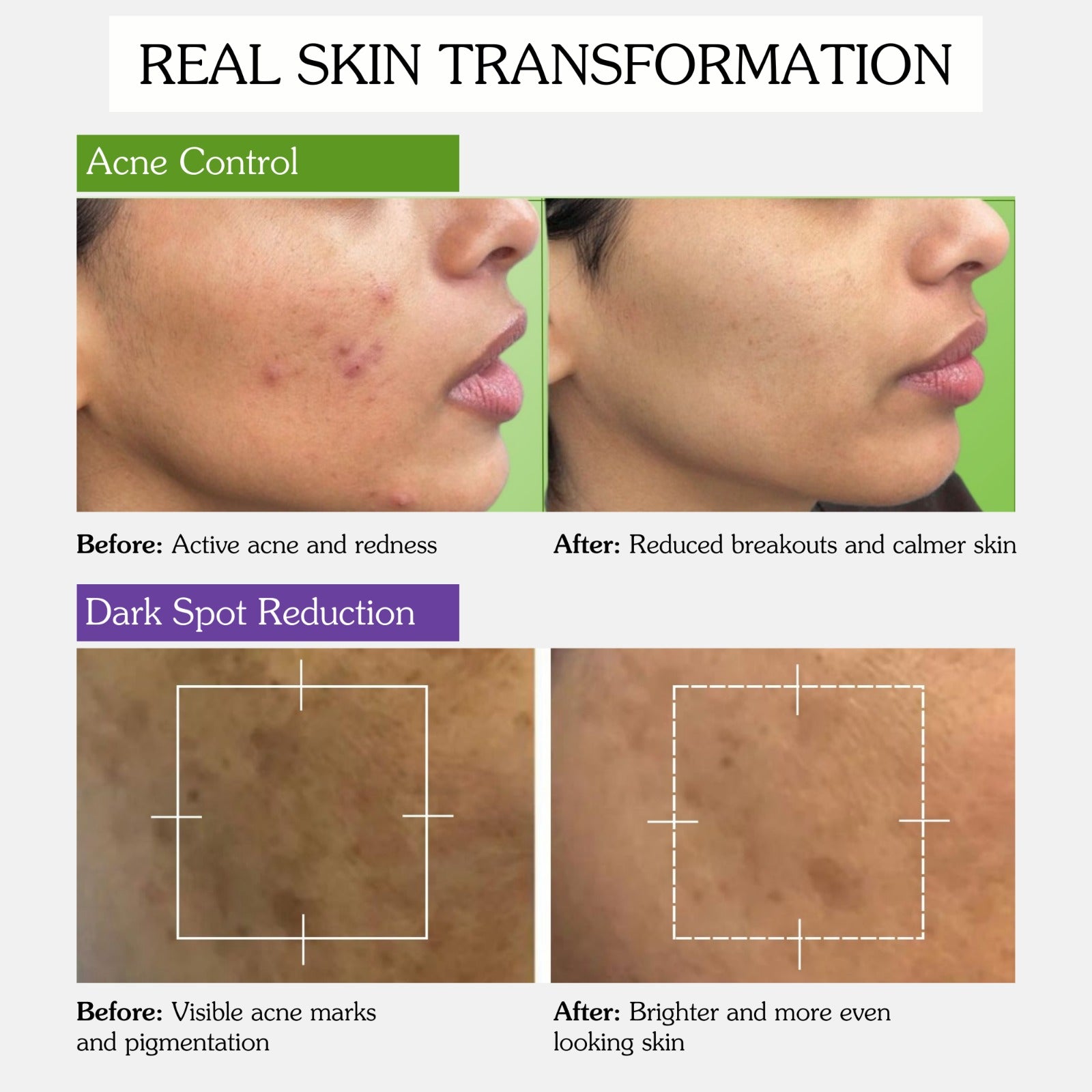 Before and after results showing reduced acne, breakouts and dark spots for clearer skin
