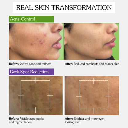 Before and after results showing reduced acne, breakouts and dark spots for clearer skin