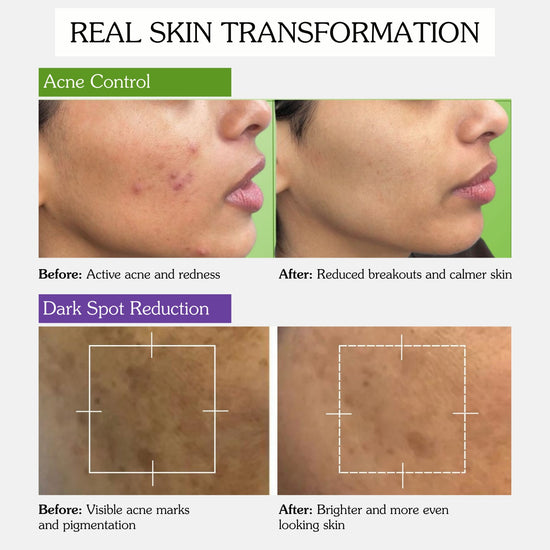 Before and after results showing reduced acne, breakouts and dark spots for clearer skin