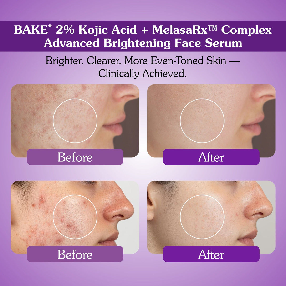 Before and after results of Bake 2% kojic acid and MelasaRx brightening face serum showing reduced pigmentation and acne marks
