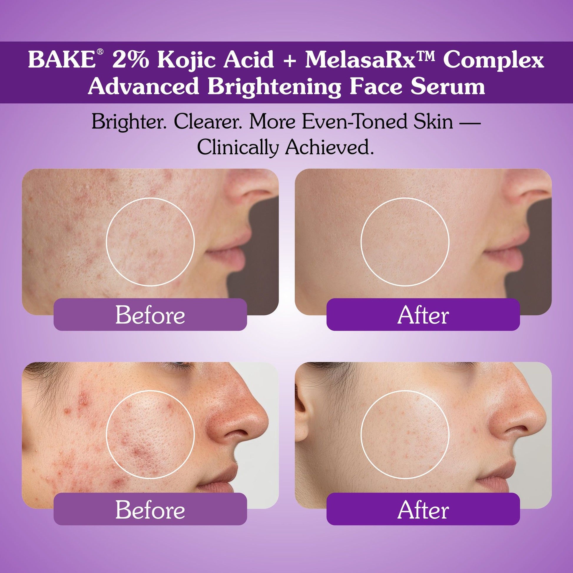 Before and after results of Bake 2% kojic acid and MelasaRx brightening face serum showing reduced pigmentation and acne marks