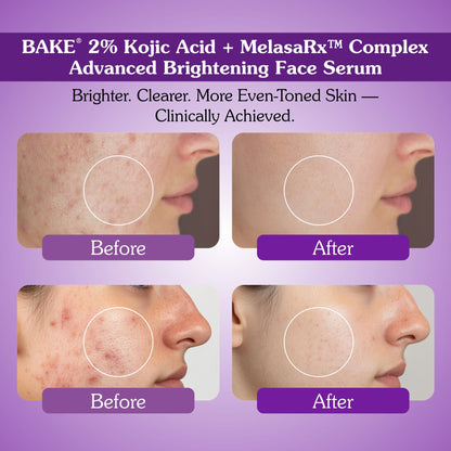 Before and after results of Bake 2% kojic acid and MelasaRx brightening face serum showing reduced pigmentation and acne marks