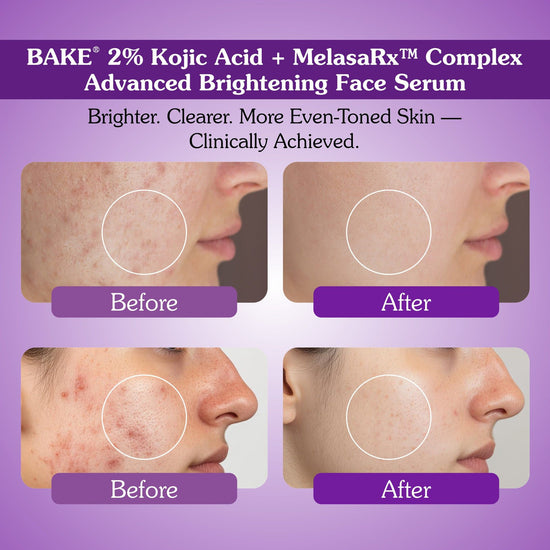Before and after results of Bake 2% kojic acid and MelasaRx brightening face serum showing reduced pigmentation and acne marks