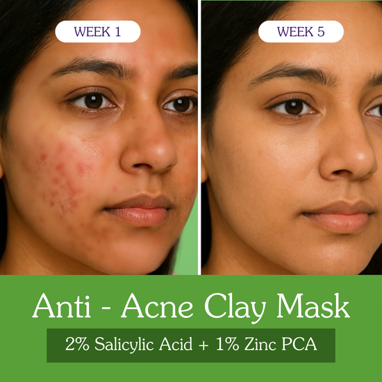 variant-Acne Clearing Mask